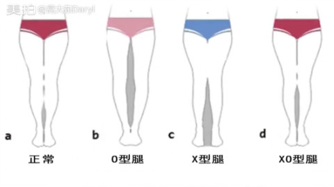 完美直腿教程之O型腿